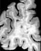 Binswanger's subcortical arteriosclerotic encephalopathy